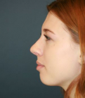 Feel Beautiful - Nose Surgery San Diego 184 - After Photo